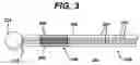 Fig. 06 - Bipolar electrosurgical snare