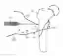 Fig. 01 - Surgical instrument, and related methods