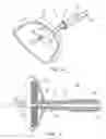 Fig. 06 - Method and apparatus for anastomosis including expandable anchor