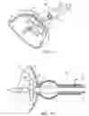 Fig. 06 - Method and apparatus for radical prostatectomy anastomosis