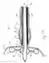 Fig. 07 - Method and apparatus for radical prostatectomy anastomosis