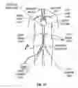 Fig. 40 - Method and apparatus for patient temperature control employing administration of anti-shivering agents