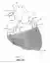 Fig. 02 - Cardiac harness and method of delivery by minimally invasive access