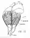 Fig. 30 - Cardiac harness and method of delivery by minimally invasive access