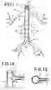 Fig. 02 - Helical stent for branched vessel prosthesis