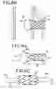 Fig. 04 - Helical stent for branched vessel prosthesis