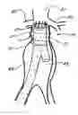 Fig. 01 - Device for use in intraluminal grafting