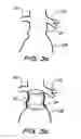 Fig. 03 - Device for use in intraluminal grafting