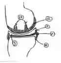 Fig. 01 - Unicondylar knee implant