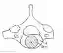 Fig. 01 - Cervical prosthesis and instrument set