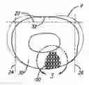 Fig. 01 - Method for installation of manufactured implants shaped to conform to a prepared implantation space