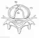 Fig. 01 - Spinal arthroplasty device and method