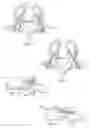 Fig. 04 - Spinal arthroplasty device and method