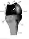 Fig. 01 - Device and method for bicompartmental arthroplasty