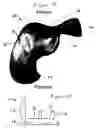 Fig. 02 - Device and method for bicompartmental arthroplasty