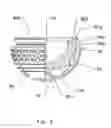 Fig. 07 - Expandable, supporting acetabular cup