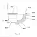 Fig. 09 - Expandable, supporting acetabular cup