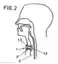 Fig. 03 - Hemi-cannula for tracheotomy patients