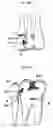 Fig. 02 - System for the controlled delivery of an active material to a dental site