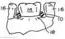 Fig. 01 - Method and device for positioning gum line about dental replacement teeth surfaces
