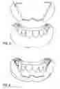 Fig. 03 - Cosmetic prosthesis