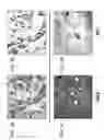 Fig. 04 - MTA1 is a predictive and prognostic factor in human breast cancer