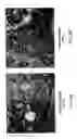 Fig. 05 - MTA1 is a predictive and prognostic factor in human breast cancer