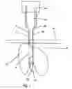 Fig. 02 - Needle with lateral aperture