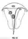Fig. 10 - Method and system for photoselective vaporization for gynecological treatments
