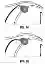 Fig. 11 - Method and system for photoselective vaporization for gynecological treatments