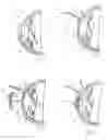 Fig. 02 - Method and apparatus for reshaping the cornea by controlled thermal delivery