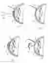 Fig. 03 - Method and apparatus for reshaping the cornea by controlled thermal delivery