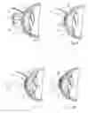 Fig. 06 - Method and apparatus for reshaping the cornea by controlled thermal delivery