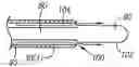 Fig. 01 - Irrigation sheath
