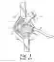 Fig. 02 - Minimally invasive orthopaedic apparatus and methods