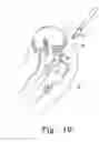 Fig. 10 - Minimally invasive orthopaedic apparatus and methods