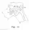 Fig. 14 - Minimally invasive orthopaedic apparatus and methods