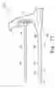 Fig. 17 - Minimally invasive orthopaedic apparatus and methods