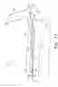 Fig. 19 - Minimally invasive orthopaedic apparatus and methods