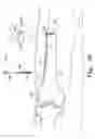 Fig. 32 - Minimally invasive orthopaedic apparatus and methods
