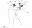 Fig. 07 - Implantable screw for stabilization of a joint or a bone fracture