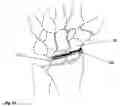 Fig. 09 - Implantable screw for stabilization of a joint or a bone fracture