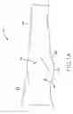 Fig. 02 - Method and apparatus for performing a minimally invasive total hip arthroplasty