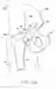 Fig. 04 - Method and apparatus for performing a minimally invasive total hip arthroplasty