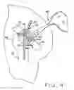 Fig. 08 - Method and apparatus for performing a minimally invasive total hip arthroplasty