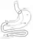Fig. 01 - Devices and methods for treating morbid obesity
