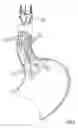 Fig. 08 - Devices and methods for treating morbid obesity