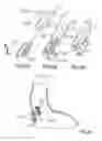 Fig. 28 - Devices and methods for treating morbid obesity
