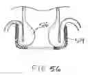 Fig. 41 - Devices and methods for treating morbid obesity