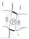 Fig. 07 - Method and device for treating osteoarthritis and cartilage disease, defects, and injuries in the human hip
